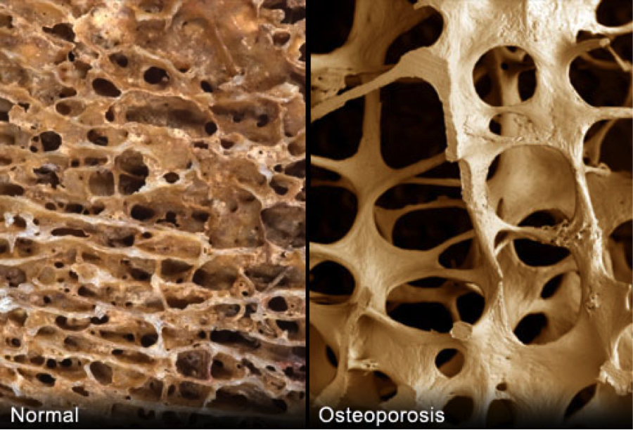 Left: normal bones. Right: bones with osteoporosis